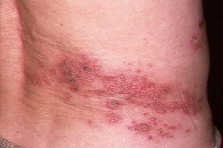 Illustration for article titled Obat Penyakit Herpes Sembuh Tuntas